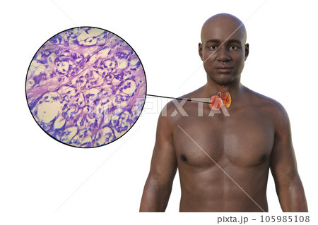 Thyroid cancer, 3D illustration Thyroid cancer, 3D illustration 105985108