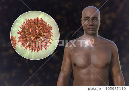 Thyroid cancer, 3D illustration 105985110
