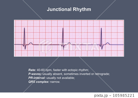 Electrocardiogram displaying a junctional rhythm, 3D illustration 105985221