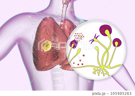 Lung mucormycosis lesion and close-up view of Rhizopus fungi, 3D illustration Lung mucormycosis lesion and close-up view of Rhizopus fungi, 3D illustration 105985263