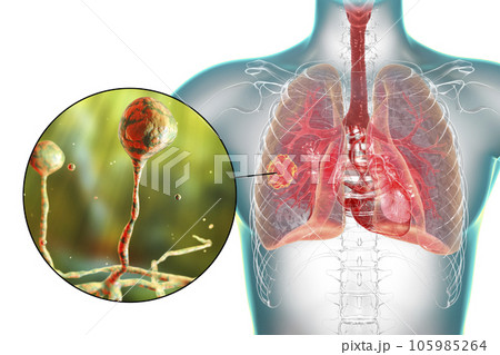 Lung mucormycosis lesion and close-up view of Rhizopus fungi, 3D illustration Lung mucormycosis lesion and close-up view of Rhizopus fungi, 3D illustration 105985264