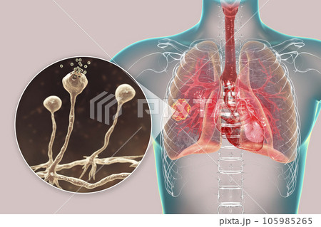 Lung mucormycosis lesion and close-up view of Rhizopus fungi, 3D illustration 105985265