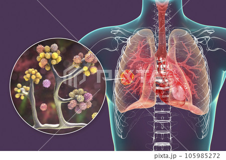 Lung mucormycosis lesion caused by Cunninghamella bertholletiae fungi, 3D illustration Lung mucormycosis lesion caused by Cunninghamella bertholletiae fungi, 3D illustration 105985272