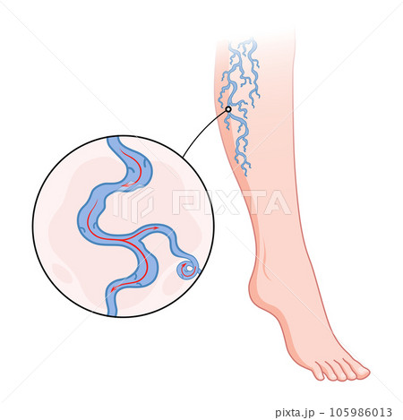 Varicose veins. Blue blood vessel visible through the skin, abnormally swollen leg. Vascular disease diagnostic and treatment. Venous insufficiency medical disease 105986013