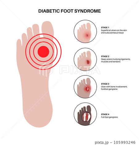 Diabetic Foot Ulcers 105993246