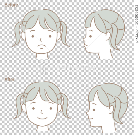 Children's faces with opposite occlusion, before and after orthodontic treatment Children's faces with opposite occlusion, before and after orthodontic treatment 106009853