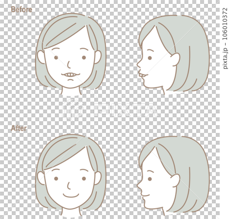 The face of a child with buck teeth, before and... - Stock Illustration ...