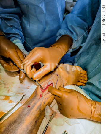 When faced with leg fracture, surgeons opt for installation of metal plate during surgery. When faced with leg fracture, surgeons opt for installation of metal plate during surgery. 106021643