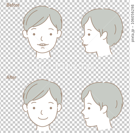 齙牙儿童的臉，正畸治療前後 106056298