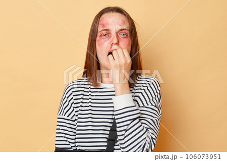 Scared woman with bruises and injuries wearing striped shirt standing isolated over beige background victim of violence crying felling despair needs help. Scared woman with bruises and injuries wearing striped shirt standing isolated over beige background victim of violence crying felling despair needs help. 106073951