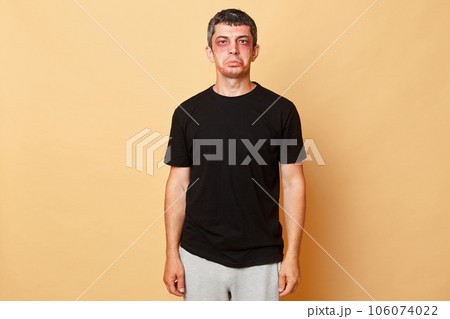 Upset offended injured man in black T-shirt with bruises and abrasions on his face isolated over beige background being sad after accident and traumas. Upset offended injured man in black T-shirt with bruises and abrasions on his face isolated over beige background being sad after accident and traumas. 106074022