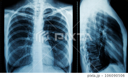 Frontal and lateral projections of a female chest x-ray Frontal and lateral projections of a female chest x-ray 106090506