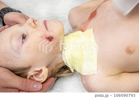 dressing a boy with a burn from boiling water dressing a boy with a burn from boiling water 106090793