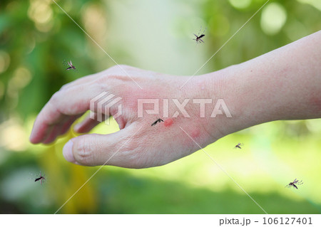 Mosquitoes bite on adult hand made skin rash and allergy with red spot Mosquitoes bite on adult hand made skin rash and allergy with red spot 106127401