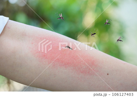 Mosquito bite on adult arm with skin rash and allergy with red spot Mosquito bite on adult arm with skin rash and allergy with red spot 106127403