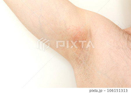 Allergy underarm. Cropped photo of irritation, inflammation on the sensitive skin after using a razor, trimmer, toxic deodorant or antiperspirant. Armpit rash. Atopic dermatitis. Acne or red spots. Allergy underarm. Cropped photo of irritation, inflammation on the sensitive skin after using a razor, trimmer, toxic deodorant or antiperspirant. Armpit rash. Atopic dermatitis. Acne or red spots. 106151313