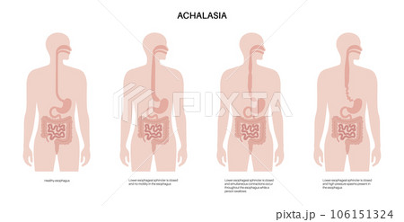 Esophageal achalasia disease 106151324