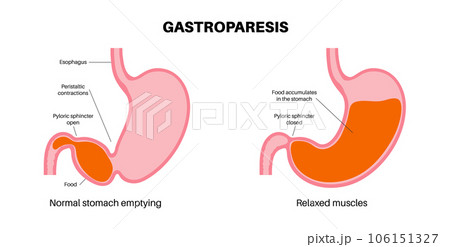 Gastroparesis anatomical poster Gastroparesis anatomical poster 106151327
