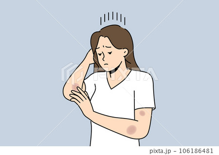 Woman with bruises on arms is sad and looks at abrasions received after fall or accident on road 106186481