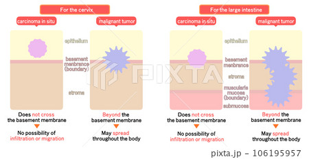 上皮内新生物と悪性新生物の違い 上皮内新生物と悪性新生物の違い 106195957