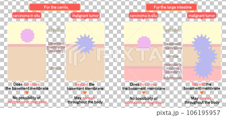 上皮内新生物と悪性新生物の違い 上皮内新生物と悪性新生物の違い 106195957