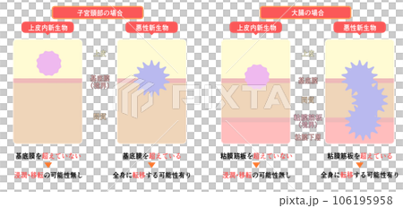Difference Between Intraepithelial Neoplasm and Malignant Neoplasm Difference Between Intraepithelial Neoplasm and Malignant Neoplasm 106195958