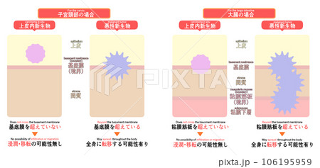 上皮内新生物と悪性新生物の違い 106195959