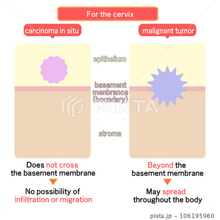 上皮内新生物と悪性新生物の違い 106195960