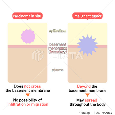 上皮内新生物と悪性新生物の違い 106195963