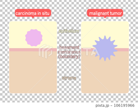 Difference Between Intraepithelial Neoplasm and Malignant Neoplasm 106195966