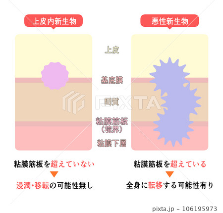 上皮内新生物と悪性新生物の違い 上皮内新生物と悪性新生物の違い 106195973