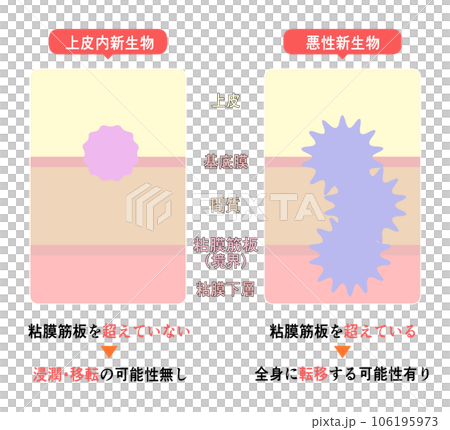 上皮内新生物と悪性新生物の違い 上皮内新生物と悪性新生物の違い 106195973