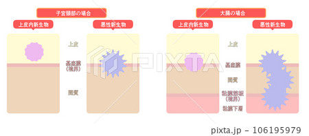 上皮内新生物と悪性新生物の違い 106195979