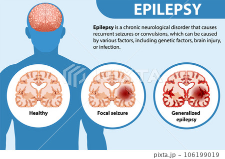 Informative poster of Epilepsy 106199019