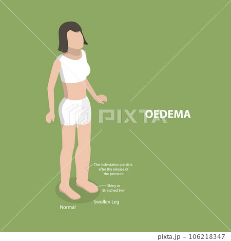 3D Isometric Flat Vector Conceptual Illustration of Oedema 3D Isometric Flat Vector Conceptual Illustration of Oedema 106218347