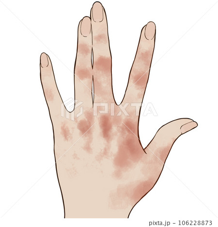 手湿疹のイラスト 手湿疹のイラスト 106228873