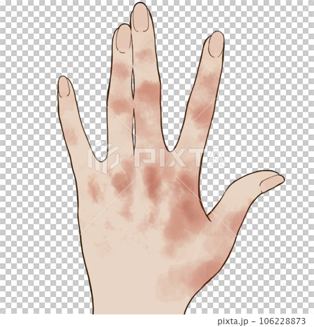 手湿疹のイラスト 手湿疹のイラスト 106228873