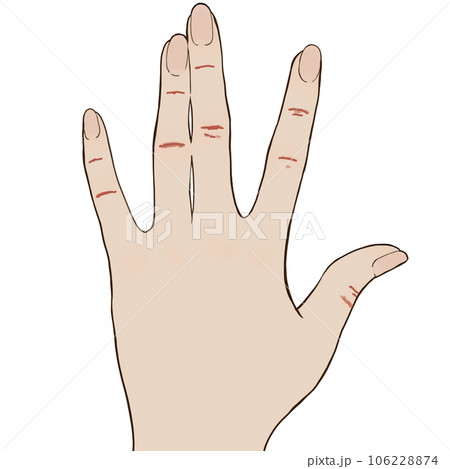 あかぎれのイラスト あかぎれのイラスト 106228874