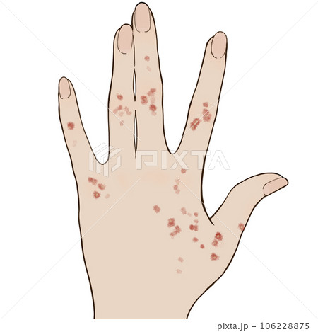 ぶつぶつの湿疹イラスト ぶつぶつの湿疹イラスト 106228875