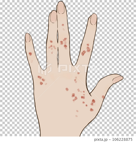 ぶつぶつの湿疹イラスト ぶつぶつの湿疹イラスト 106228875