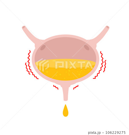 Overactive bladder. Urinal overflow. Stress signal, disorder and medical dysfunction of human body. Anatomical illustration isolated on white 106229275