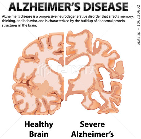 Informative poster of Alzheimers disease 106230602