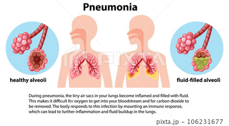Lung infection pneumonia with explanation 106231677