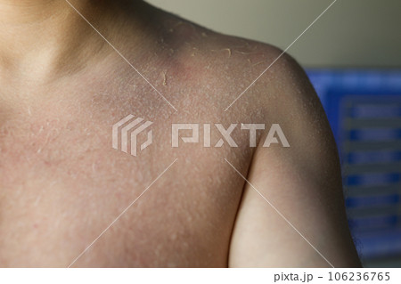 Man sunburn skin damage peeled off after exposure sun burn Man sunburn skin damage peeled off after exposure sun burn 106236765