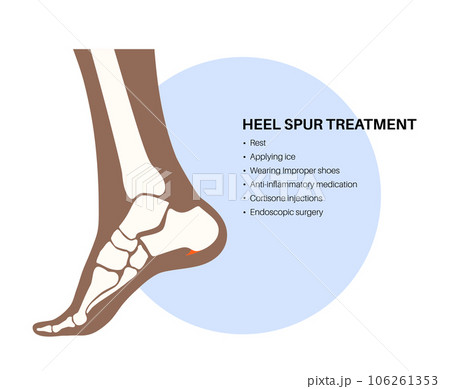 Heel spur treatment 106261353