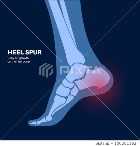 Heel spur poster 106261362