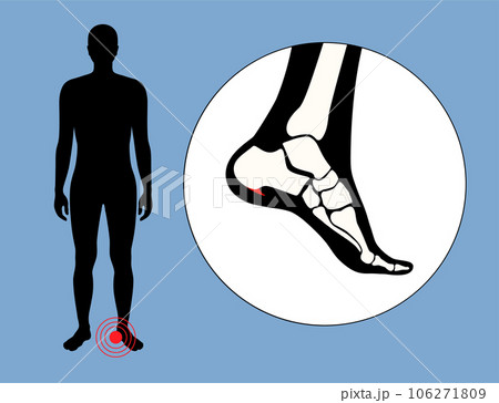 Heel spur poster 106271809