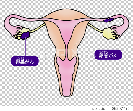Simple illustration of ovarian cancer and fallopian tube cancer Simple illustration of ovarian cancer and fallopian tube cancer 106307750