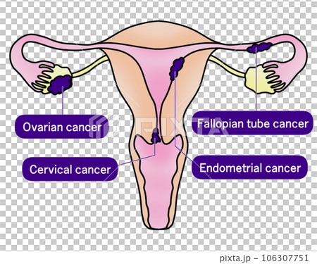 Simple illustration of cervical cancer, endometrial cancer, ovarian cancer and fallopian tube cancer Simple illustration of cervical cancer, endometrial cancer, ovarian cancer and fallopian tube cancer 106307751