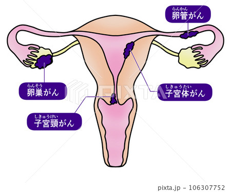 子宮頸がんと子宮体がんと卵巣がんと卵管がんのシンプルなイラスト 106307752